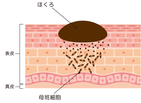 ほくろ除去とは？