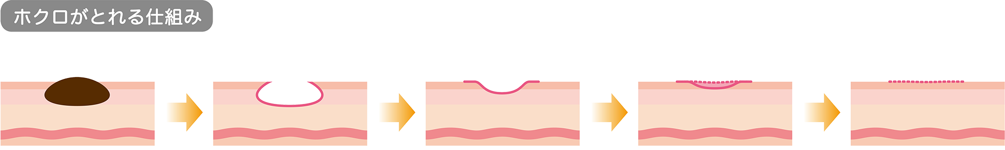 ホクロがとれる仕組み