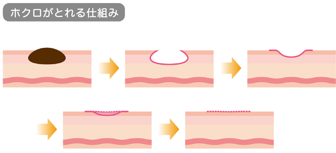 ホクロがとれる仕組み