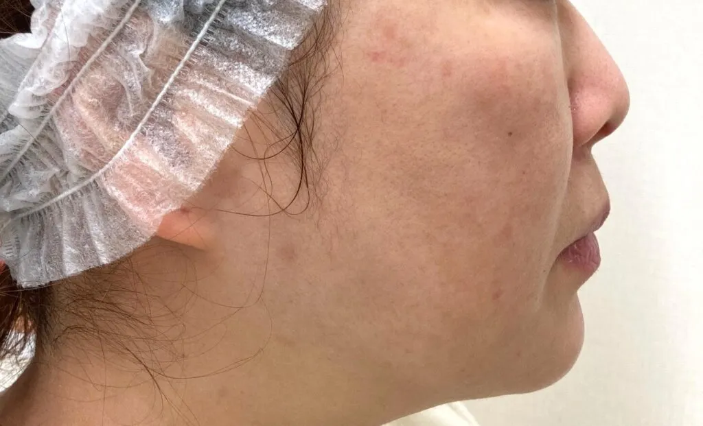 シミ取りの症例 after