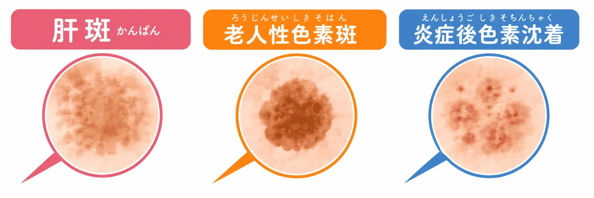 肝斑かどうかを見極める診察の様子
