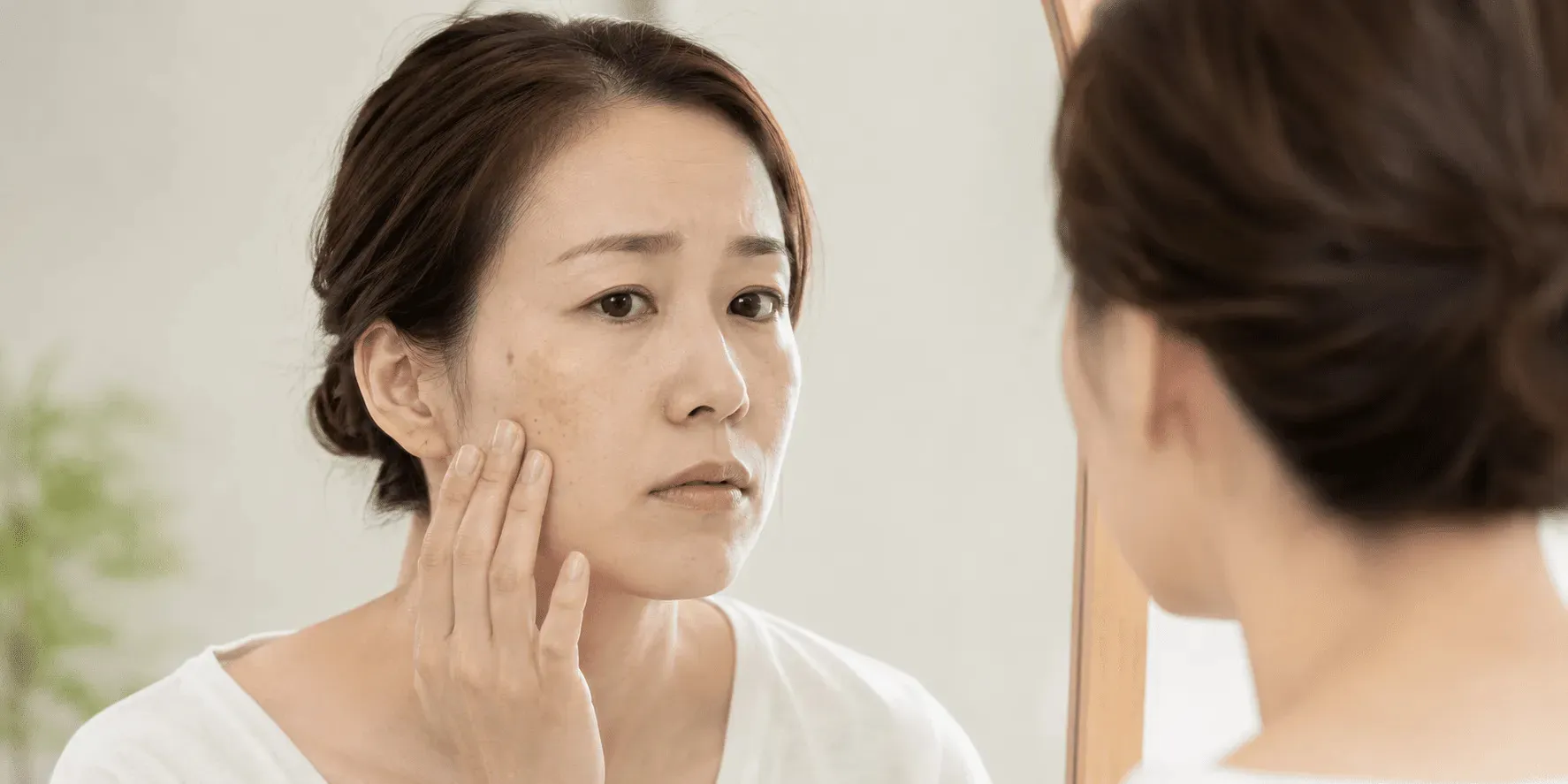 頬に左右対称に広がる肝斑のイメージ