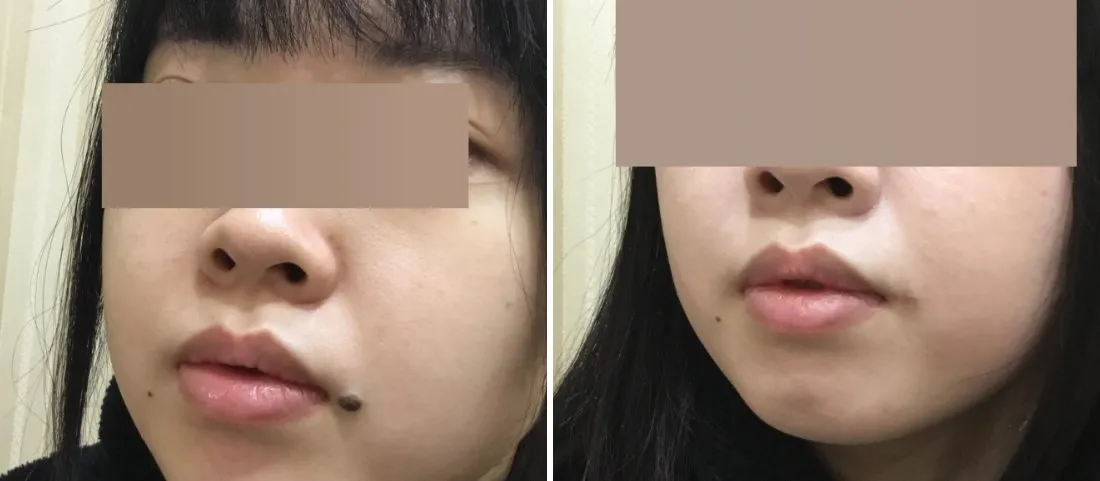 ほくろ除去の症例写真(施術前・施術後)口元・口角横