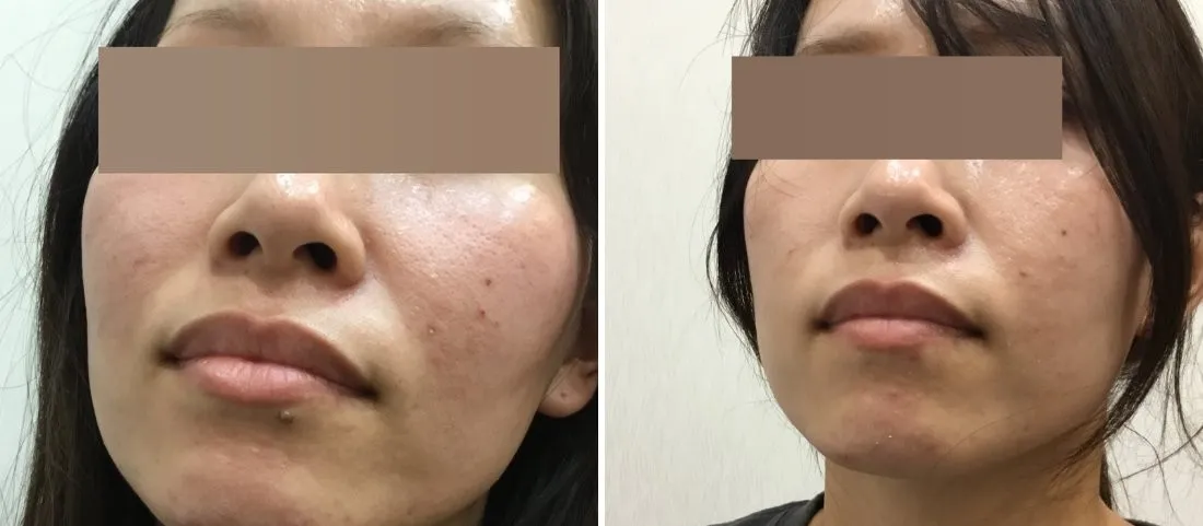ほくろ除去の症例写真（施術前・施術後）口元・唇下