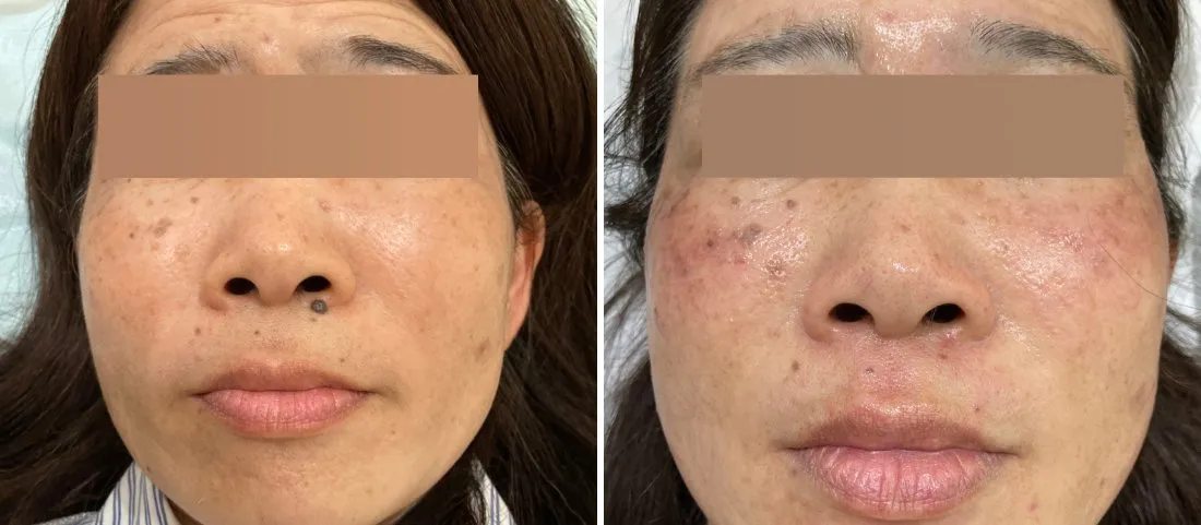 ほくろ除去の症例写真(施術前・施術後)鼻・鼻下