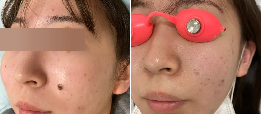 ほくろ除去の症例写真(施術前・施術後)頬・ほうれい線横