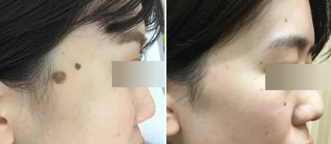 ほくろ除去の症例写真(施術前・施術後)こめかみ・顎・こめかみ